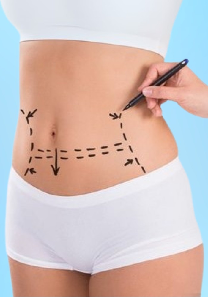 Tummy Tuck