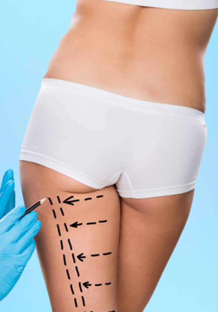 Thigh Lift